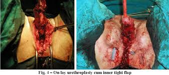 Though it usually affects your extremities, like your toes and fingers, it can also affect your internal organs. Pdf Fournier S Gangrene Fournierova Gangrena Semantic Scholar