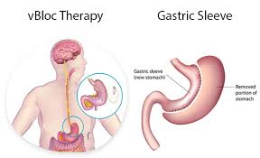 Pin On Bariatric Surgery