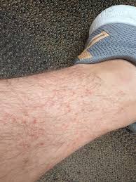 Image result for liver spots on legs