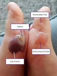 We did not find results for: Blister Fluid Colours What S Inside Your Blister Blister Prevention