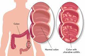 I have ulcerative colitis and have been in a flare for about six months now. Ulcerative Colitis Mydr Com Au