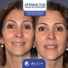 PARA LAGO AGRIO Y QUITO! 🚨👀 Solo trabajamos con resultados naturales,  ¡por eso se ve como se ve! 👑 Con un dolor mínimo y resultados al instante,  las citas se están acabando