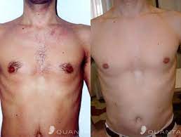 The average cost of laser hair removal is $429. Vermont Laser Services Burlington Vermont Laser Hair Removal Vermont Laser Services