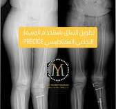‫أشعة مراحل تطويل و إلتئام عظام الساق باستخدام المسمار النخاعي المغناطيسي  PRECICE المخصص لتطويل العظام. استخدمنا طريقة معقدة و نادرة للتطويل و تصحيح  التقوس لعلاج المريض و الطريقة مريحة و مناسبة مع ...‬‎