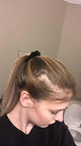Is This Balding This Happens When I Put My Hair In A Ponytail Please Help Hair Beauty Skin Deals Me Fashion Love Celebrity Hair Colors Ponytail Hair