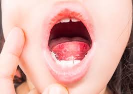 Sie wird durch das herpes virus ausgelöst und auch als gingivostomatitis herpetica bezeichnet. Was Kinder Bei Herpangina Hand Mund Fuss Krankheit Gerne Essen