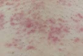 The body reacts to this, and many people experience redness and irritation in the affected areas. Are These Red Spots Normal After Laser Hair Removal How Long Do They Normally Last