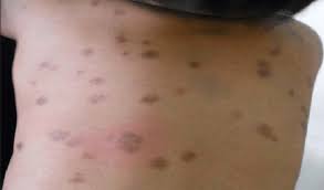 Image result for Urticaria pigmentosa children