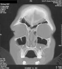 Sinusitis