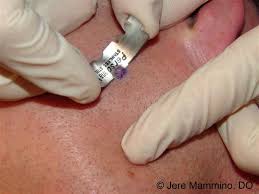 A shave biopsy involves using a local anesthetic to remove the top layers of skin by shaving it off. Biopsy American Osteopathic College Of Dermatology Aocd