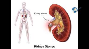 How To Remove Kidney Stones In A Day Healer Baskar Peace O Master Youtube