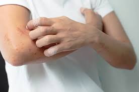 Maybe you would like to learn more about one of these? Infeksi Kulit Gejala Penyebab Dan Cara Mengobati Halodoc Com