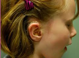 Cool Idea Cochlear Implant Transmitter That Doubles As A Girl S Hair Accessory Stylish And Functiona Cochlear Implant Girls Hair Accessories Cochlear