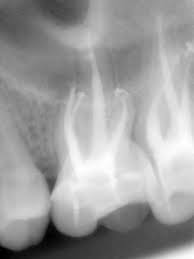 Ursache einer wurzelkanalbehandlung ist ein schaden an der pulpa, dem zahnnerv. Wurzelbehandlung Zahnarzte Gunia Bansen Ahrensburg