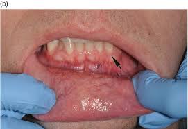 Image result for Labial mucosa
