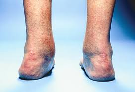 Why Does My Ankle Hurt 15 Possible Causes Of Ankle Pain