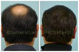 This Gentleman Is Shown Before And 17 Months After A Single Hair Transplant Session That Principally Ad Hair Transplant Results Hair Transplant Mens Hairstyles