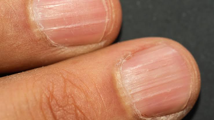 What Does It Mean When You Have Ridges On Your Fingernails?