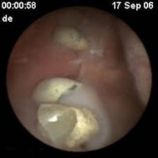 Image result for Wireless Capsule Endoscopy