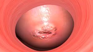 The drawing on the left shows stage ib2 cancer in the cervix that is larger than 2 cm but not larger than 4 cm. Cervical Cancer Willis Knighton Health System