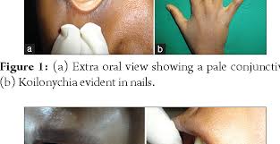 The iron deficiency is typically chronic and severe. Oral Manifestations Of Plummer Vinson Syndrome A Classic Report With Literature Review Semantic Scholar