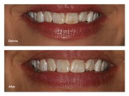 How to get rid of them? Tooth Stains Gallery Dr Jack M Hosner D D S