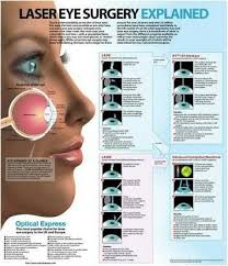 Pin By Melissa Young On Eyes Eye Surgery Laser Eye Surgery Lasik Eye Surgery