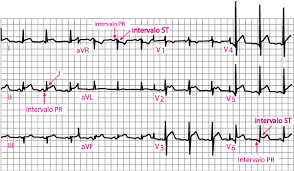 Pericardite é a inflamação do pericárdio, geralmente com acúmulo de líquido. Figure Pericardite Aguda Ecg Estagio 1 Manuais Msd Edicao Para Profissionais