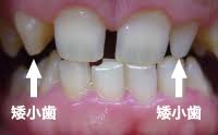 すきっ歯になる原因 少回数で治療できるすきっ歯治療法 ザ ホワイトデンタルクリニック