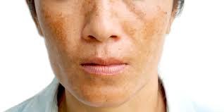 Image result for Melasma
