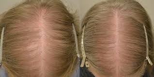 So if you have the baldness gene, you can use all the products you like that claim they fight hair loss, but at the end of the day, they are not going to stop you from going bald. Finasteride Females Before After Photos Hair Restoration Of The South New Orleans La