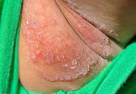 Sep 23, 2016·1 min read. Armpit Rash Causes Treatment And Prevention
