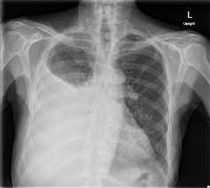 These can show if the. Large Right Pleural Effusion Jetem