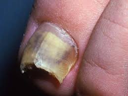 Image result for Yellow nail syndrome feet