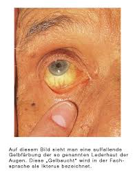 If symptoms do develop, you'll usually notice them around two to four weeks after infection. Virale Hepatitis Hepatitis A B C D E Eesom Gesundheitsportal