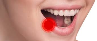 Can an infected tooth cause a fever. Cold Sores Dental Care