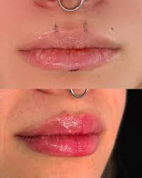 Quero fazer preenchimento labial mas tenho medo de agulhas e antes quero  fazer algo que dure menos tempo pra ver se eu gosto e se me acostumo.” A  volumização labial é a