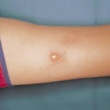 Dermatitis Fototoxica Por Contacto Con Plantas Fitofotodermatitis Download Scientific Diagram