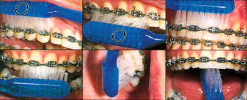 Brushing teeth with braces isn't too different than brushing without braces. How To Brush And Floss With Braces Brush N Brace San Diego Teen Dentist Orthodontist