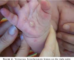 Figure 2 from X-linked incontinentia pigmenti or Bloch-Sulzberger syndrome:  a case report.