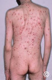 Image result for syphilis symptoms