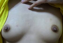 女性化乳房 - Wikipedia