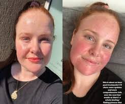 We did not find results for: Exactly What Happened When I Tried Fraxel Laser For My Pigmentation Plus My Results