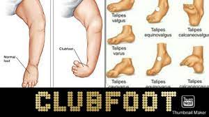 Clubfoot is a birth defect of the foot that may affect your baby's ability to walk normally. Clubfoot Its Types And Causes Simplified In Hindi Youtube