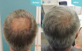 Castor oil encourage hair growth and nourishes hair efficiently. Will Castor Oil Regrow Your Hair Regrow Hair