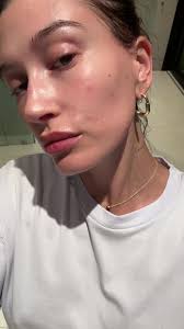 What Happened to Hailey Bieber Face