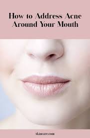 Acne Issues Reasons Why You Might Be Breaking Out Around Your Mouth Skincare Com By L Oreal In 2020 Dry Skin On Face Acne Around The Mouth Acne