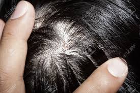 Hair loss and thinning hair is often a result of predetermined genetic factors, health and the overall aging process; Close Up Big Acne On Scalp For Medical Help Stock Photo Picture And Royalty Free Image Image 58981224