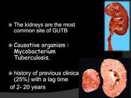 Image result for Genitourinary Tuberculosis