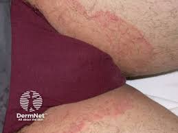 Image result for sore skin in the groin area